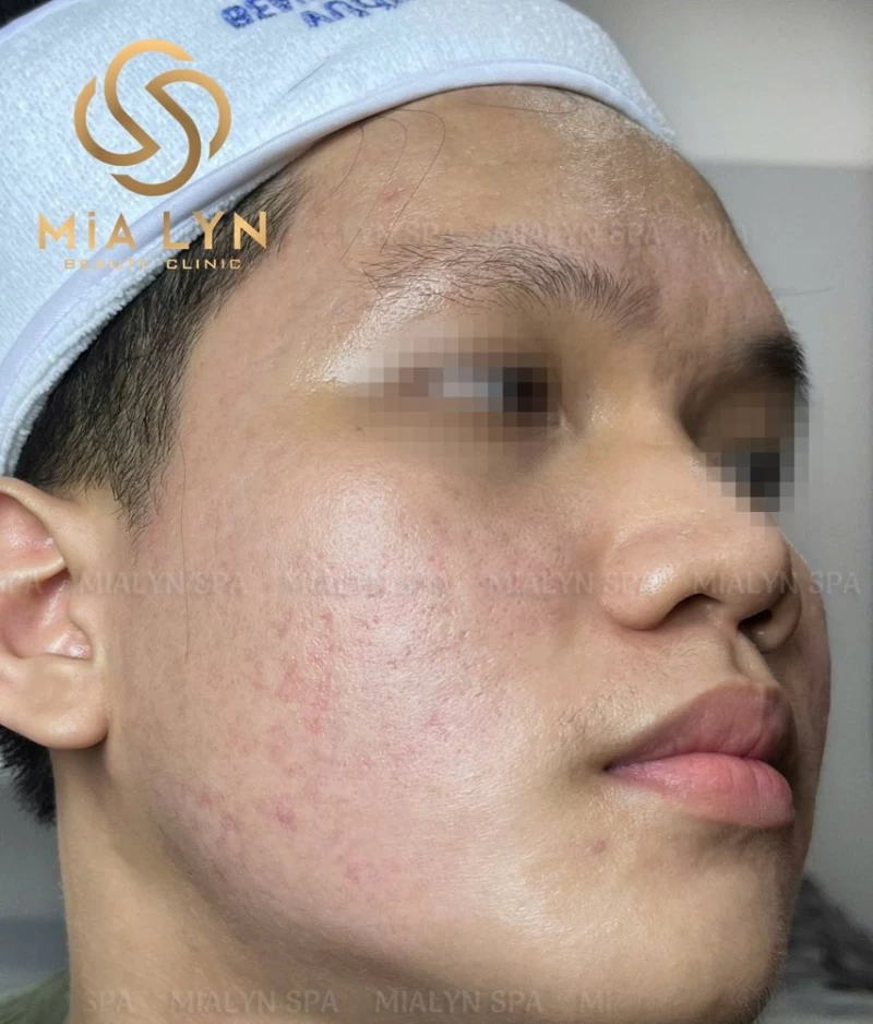 Tháng thứ 5: thâm đỏ giảm rõ, bề mặt da bắt đầu đều hơn