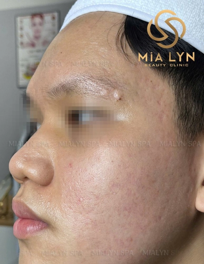 Sau 9 tháng: da sáng, mịn, sẹo rỗ li ti nông đi rõ rệt