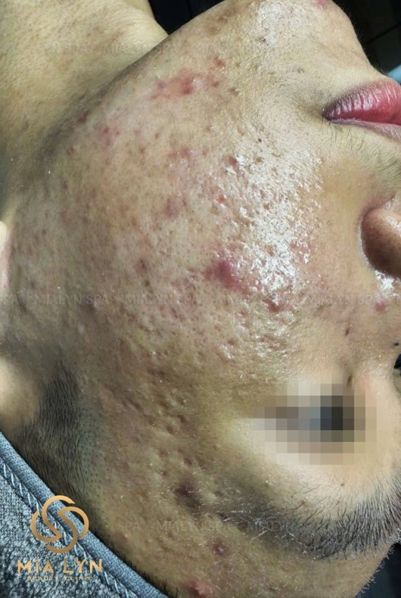 Mụn ẩn, mụn viêm và sẹo rỗ lượn sóng lan rộng trước điều trị
