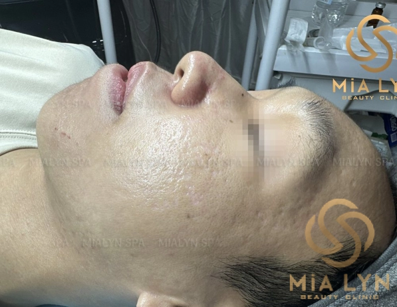 Sau 15 tháng: hết mụn, bề mặt má phẳng và mịn hơn