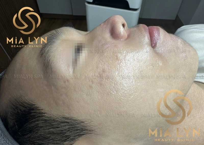 Nhìn nghiêng sau 15 tháng: sẹo lượn sóng nông đi rõ