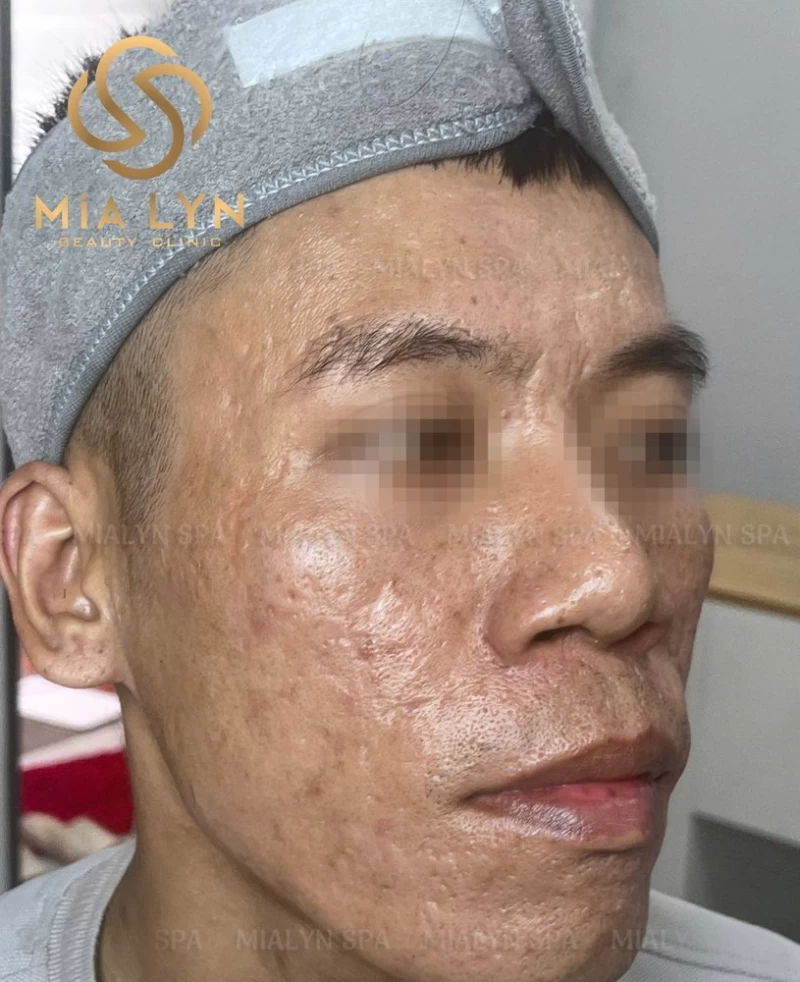 Sau 12 tháng: hết mụn viêm, đáy sẹo được nâng lên, da đều màu hơn