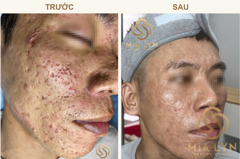Ca lâm sàng: Sẹo rỗ sâu kèm mụn viêm nặng - 12 tháng giải phóng xơ sẹo