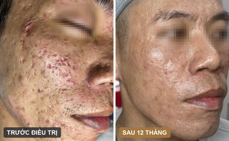 Ca lâm sàng: Sẹo rỗ sâu kèm mụn viêm nặng - 12 tháng giải phóng xơ sẹo