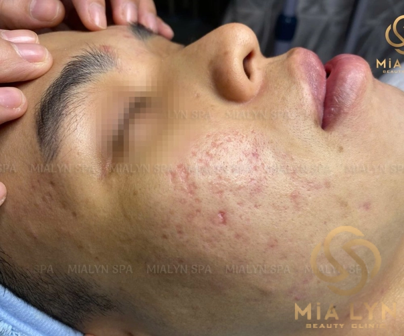 Má trái dày mụn viêm và sẹo rỗ trước điều trị