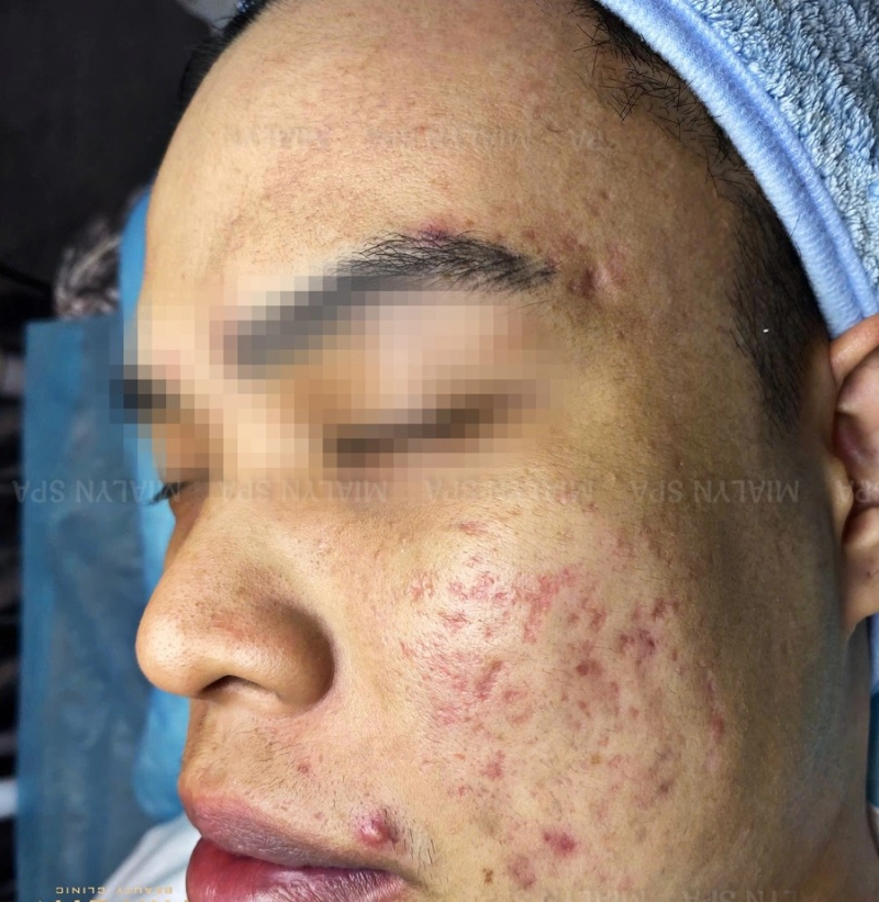 Trước điều trị - Vừa trị mụn viêm vừa trị sẹo rỗ