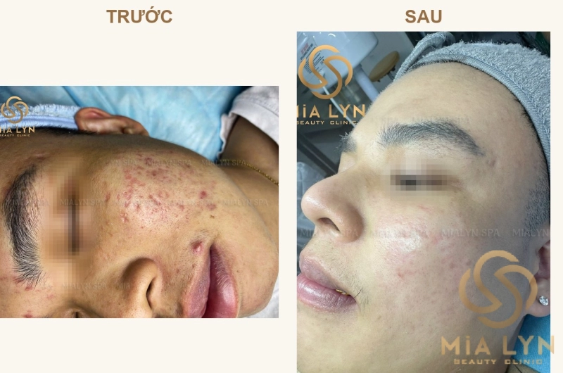 Ca lâm sàng: Vừa trị mụn viêm vừa trị sẹo rỗ trong 12 tháng ở nam 25 tuổi