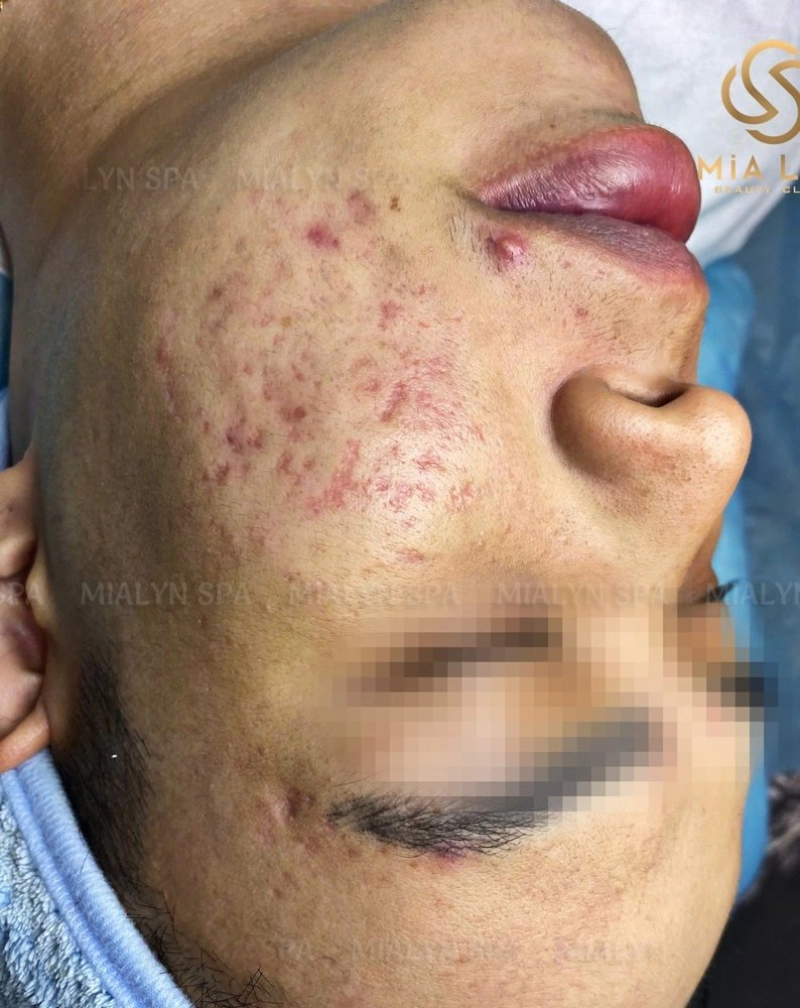 Mụn viêm, mụn mủ lan rộng vùng má khi bắt đầu điều trị