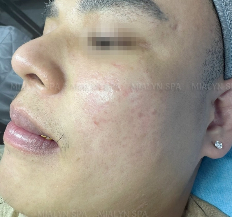 Sau điều trị - Vừa trị mụn viêm vừa trị sẹo rỗ