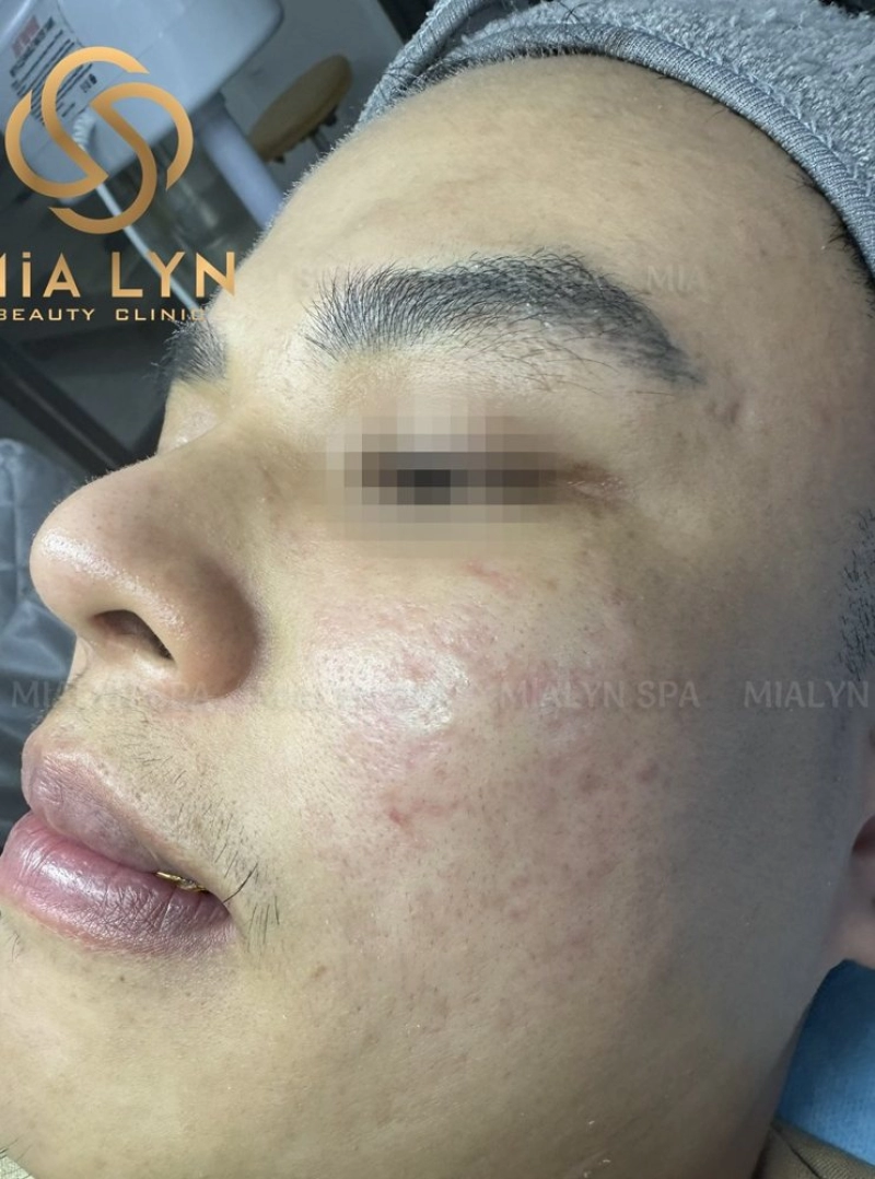 Sau 12 tháng: hết mụn viêm, sẹo nông hơn, da sáng và đều màu