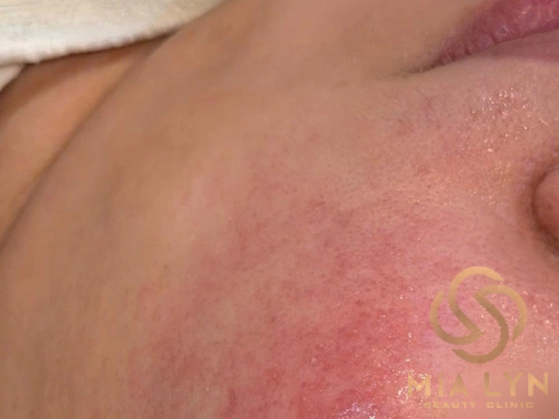 Da má đỏ, nhạy cảm cần được làm dịu và phục hồi đúng cách