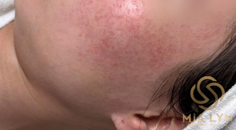 Chăm sóc da rosacea tại nhà: chọn sản phẩm và thói quen cần tránh