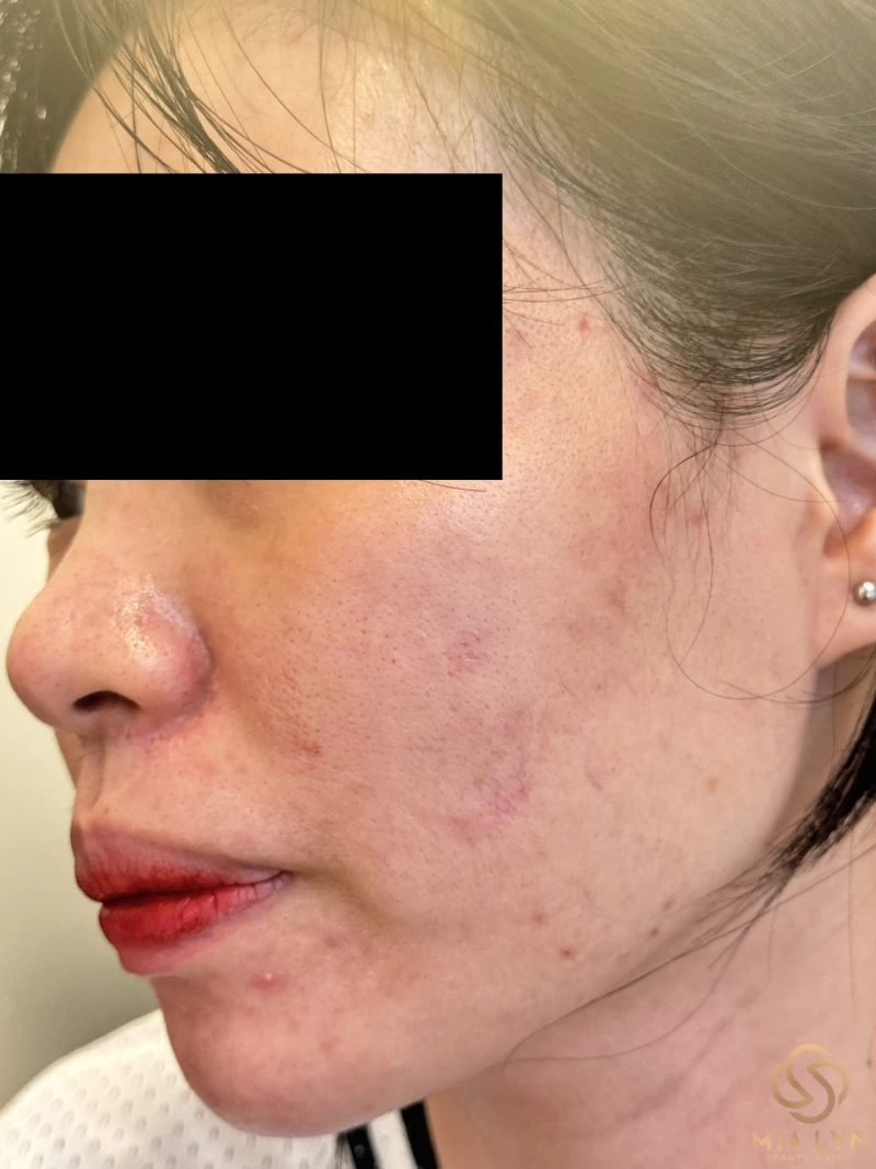 Da mụn có nên trang điểm không, cần lưu ý gì để tránh nặng hơn?