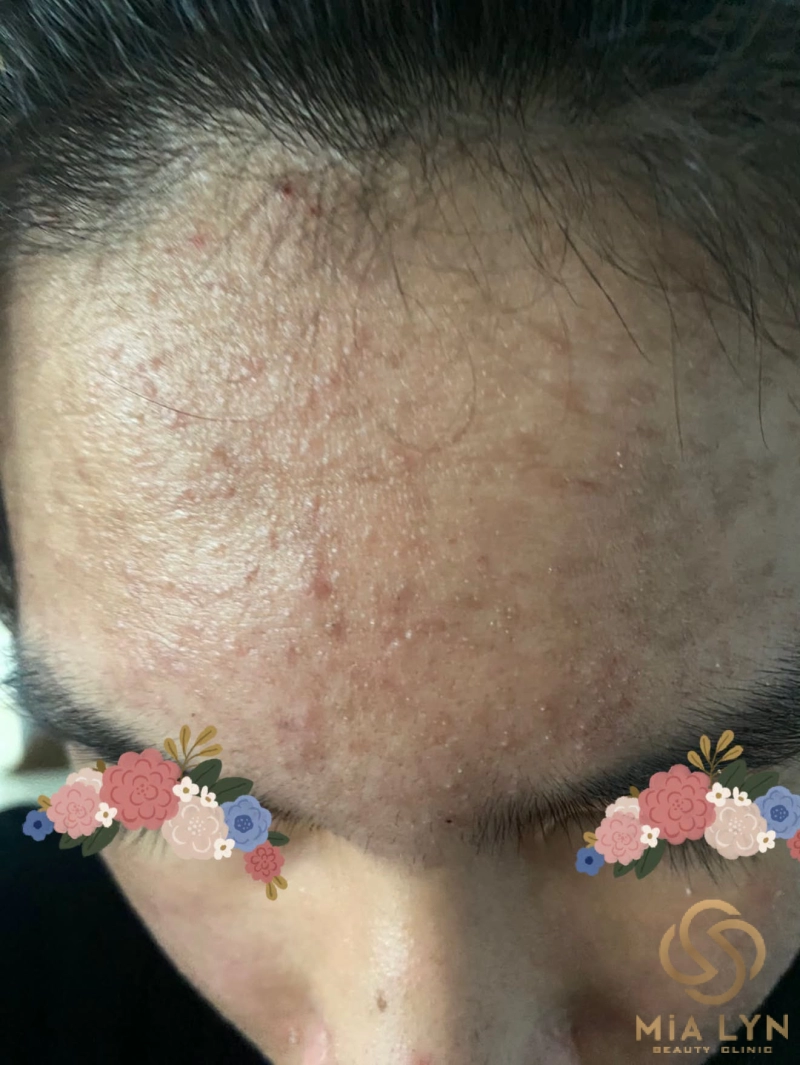 Da nhiễm corticoid là gì? Dấu hiệu nhận biết sớm