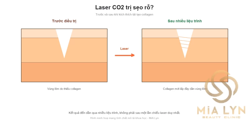 Laser CO2 trị sẹo rỗ hiệu quả đến đâu?