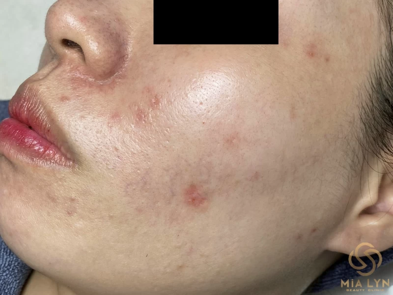 Mụn ẩn dưới da là gì, vì sao khó trị hơn mụn thông thường?