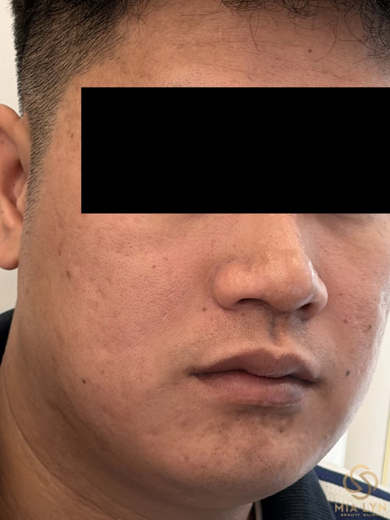 Mụn li ti không đầu là gì, có phải mụn ẩn hay mụn cám không?