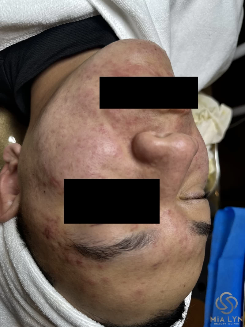 Mụn ở nam giới vì sao thường nặng hơn nữ và cách chăm sóc đúng