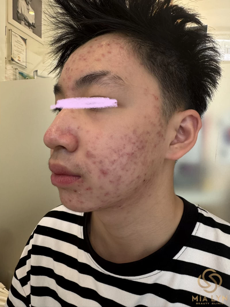 Mụn Tuổi Dậy Thì: Vì Sao Xuất Hiện Và Chăm Sóc Thế Nào?