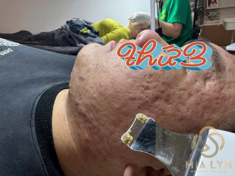 Nặn Mụn Sai Cách Gây Sẹo Như Thế Nào? Cảnh Báo Từ Chuyên Gia
