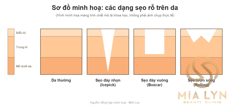 Phân biệt các loại sẹo rỗ: Icepick, Boxcar và Rolling