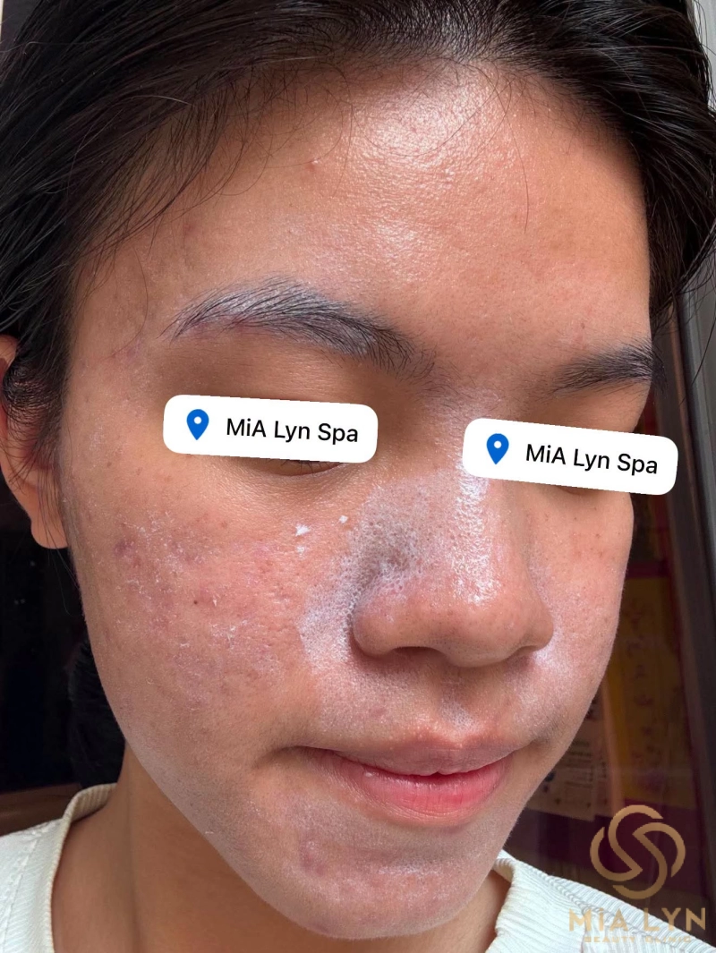 Phân biệt da nhạy cảm và da nhiễm corticoid