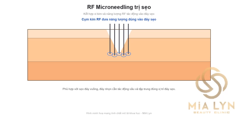 RF Microneedling trị sẹo: ứng dụng thực tế thế nào?