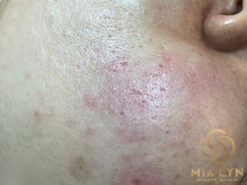 Da đỏ thành mảng ở má, lỗ chân lông giãn - dấu hiệu thường gặp ở da rosacea