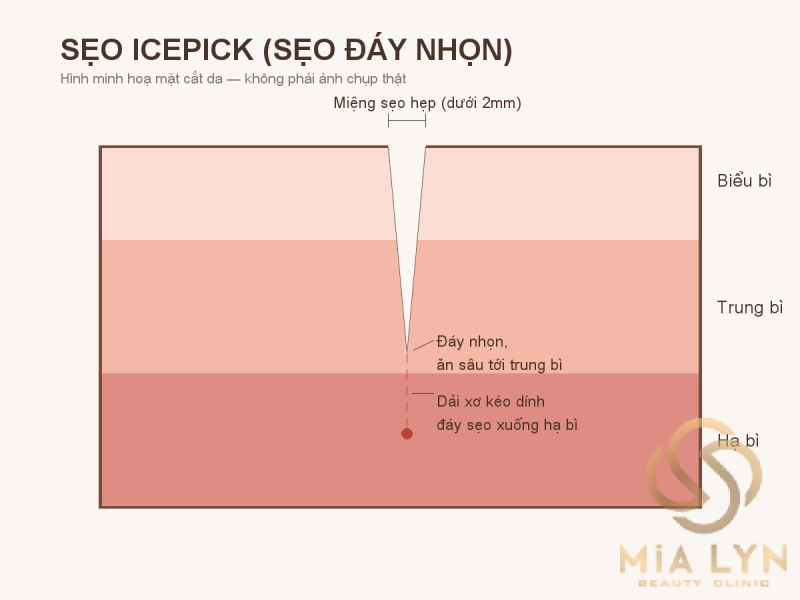 Sẹo rỗ đáy nhọn (icepick): vì sao khó trị nhất và cách xử lý