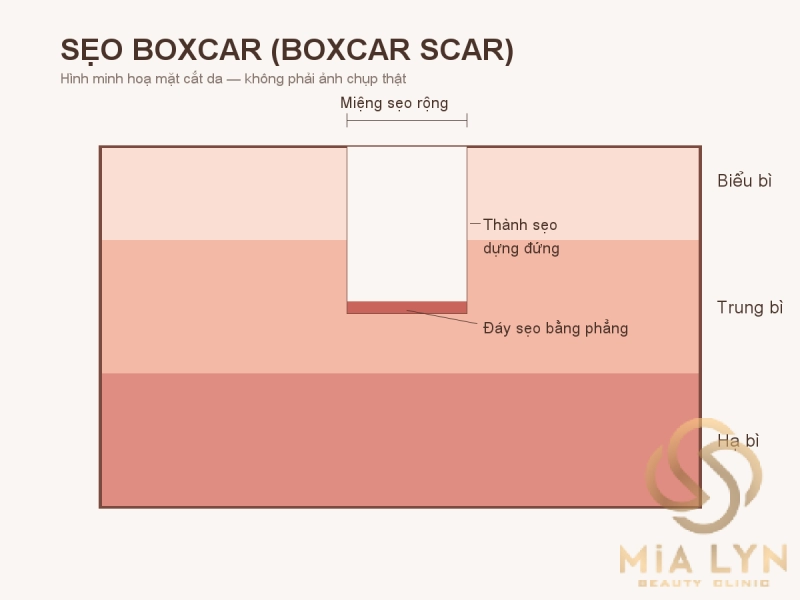 Sẹo rỗ đáy vuông (boxcar): đặc điểm và cách điều trị