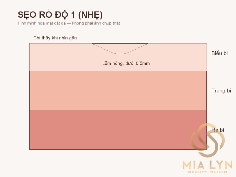 Sẹo rỗ độ 1: dấu hiệu nhận biết và cách cải thiện