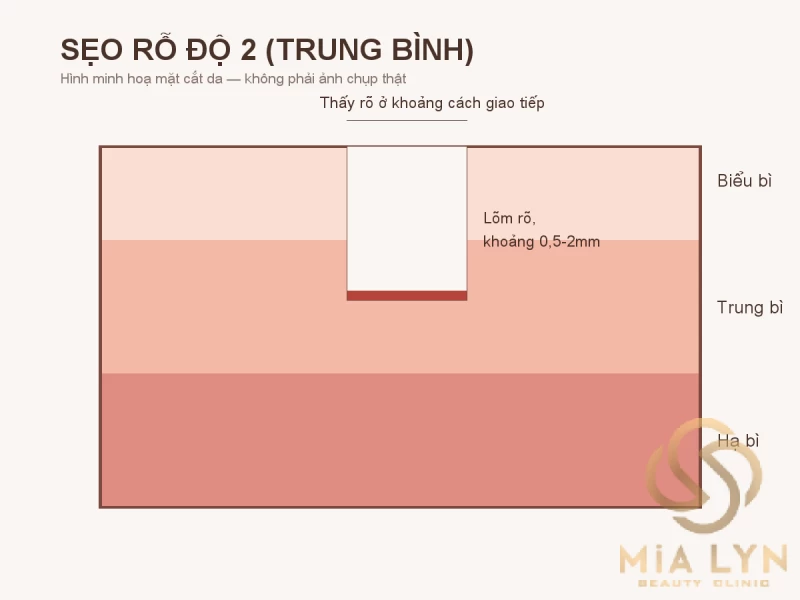 Sẹo rỗ độ 2: mức độ trung bình và hướng điều trị phù hợp