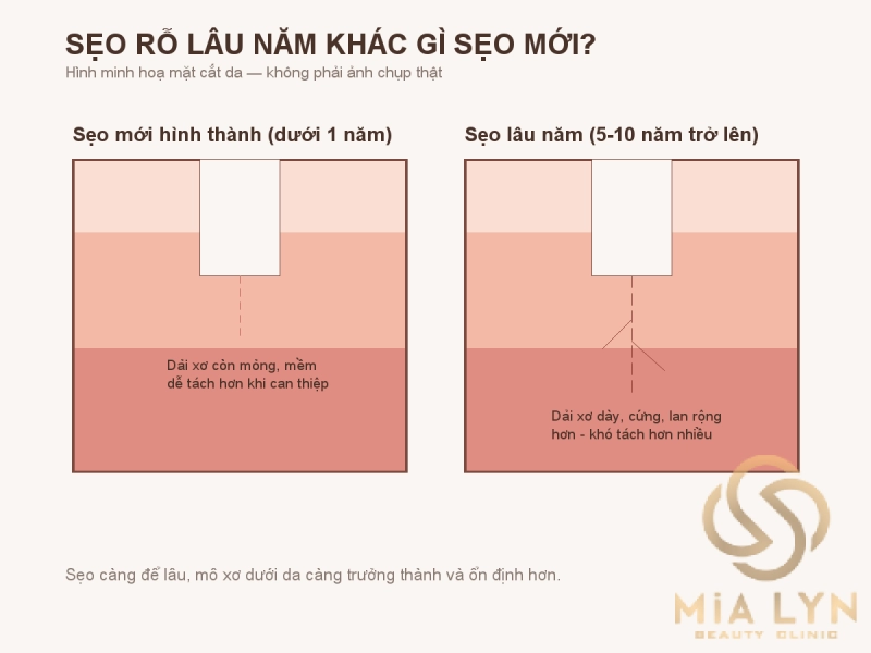 Sẹo rỗ lâu năm có còn trị được không?