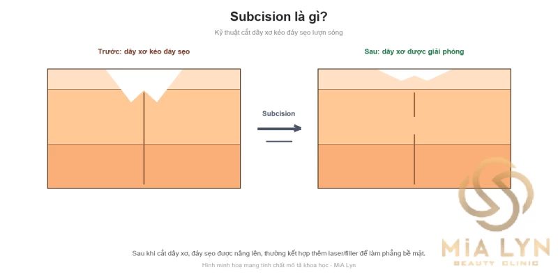 Subcision là gì? Kỹ thuật cắt dây xơ trị sẹo lượn sóng