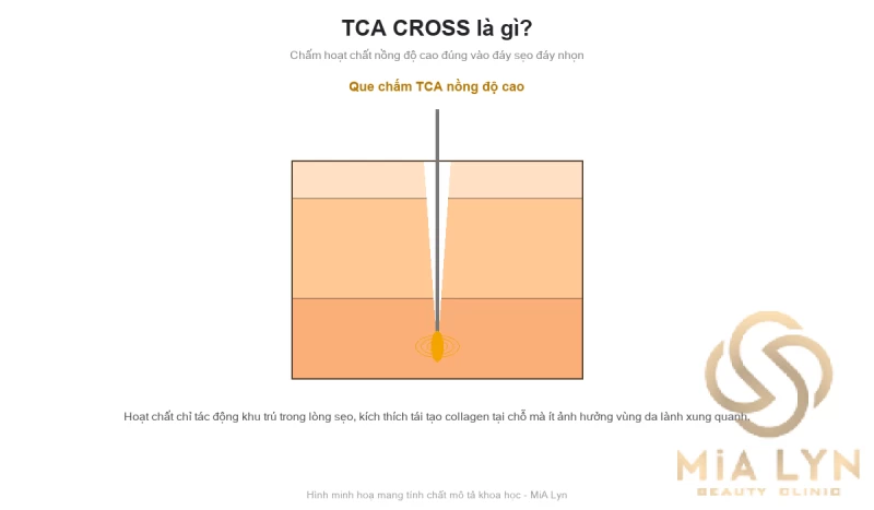 TCA CROSS là gì? Kỹ thuật chuyên biệt cho sẹo đáy nhọn