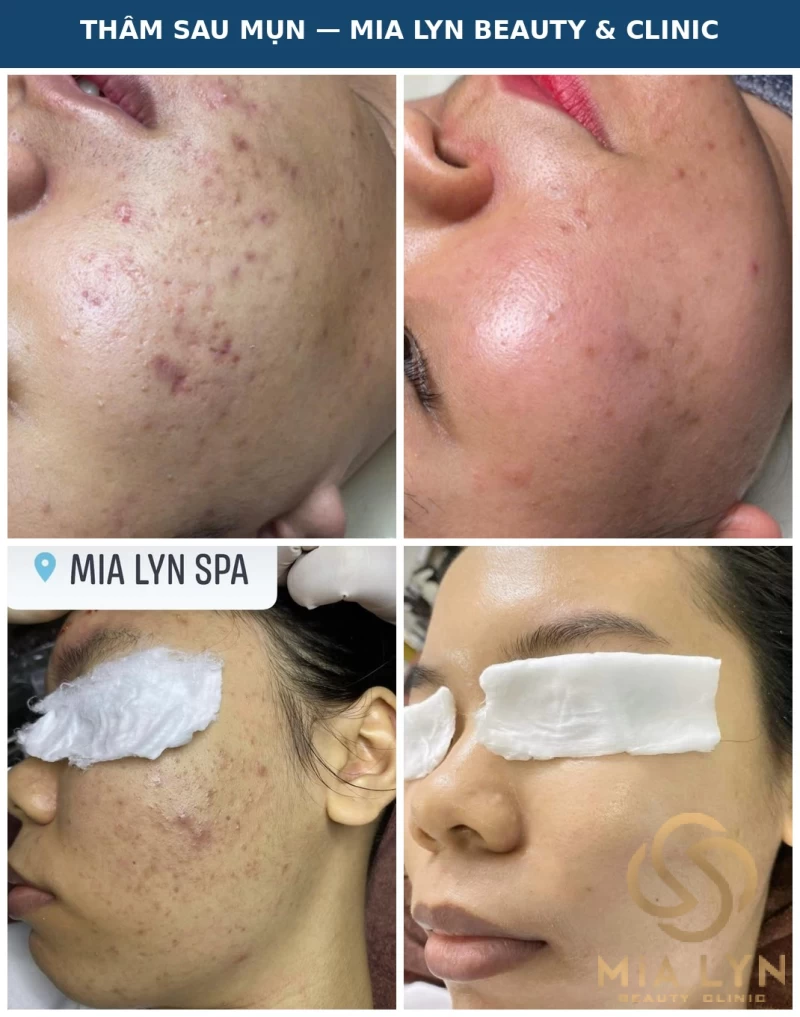 Thâm Sau Mụn Bao Lâu Thì Hết?