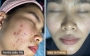 Ca lâm sàng: Hành trình 10 tháng trị mụn viêm nặng ở nữ 22 tuổi