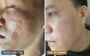Ca lâm sàng: Sẹo rỗ kèm thâm sạm sau mụn ở nam 32 tuổi - hành trình 11 tháng
