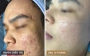 Ca lâm sàng: Vừa trị mụn viêm vừa trị sẹo rỗ trong 12 tháng ở nam 25 tuổi