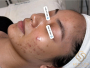Mụn nội tiết ở nữ: Dấu hiệu, nguyên nhân và hướng điều trị khoa học