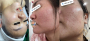 MỤN TRỨNG CÁ – VẤN ĐỀ DA LIỄU PHỔ BIẾN NHƯNG THƯỜNG BỊ HIỂU SAI