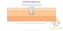 RF Microneedling trị sẹo: ứng dụng thực tế thế nào?