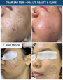 Thâm Sau Mụn Bao Lâu Thì Hết?