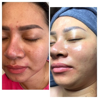 Phục hồi cho da yếu tổn thương